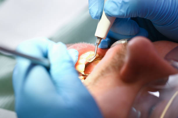 Best Emergency Root Canal Treatment in South Bend, WA